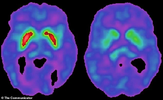 Study Reveals High Levels of Human Pegavirus in Parkinson’s Disease Brains