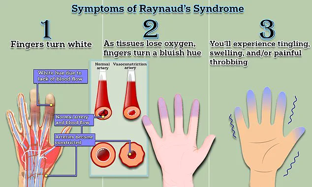 Groundbreaking Medical Discovery May Offer New Hope for Millions with Raynaud's Disease