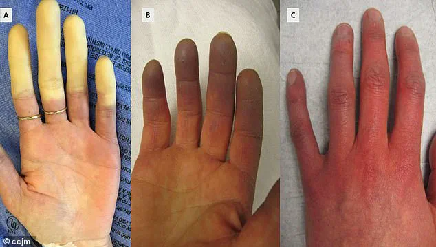 Groundbreaking Medical Discovery May Offer New Hope for Millions with Raynaud's Disease