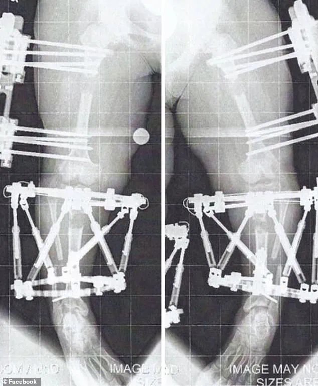 Chandler Crews: Navigating Life with Achondroplasia, a Genetic Condition Affecting 50,000 in the U.S.