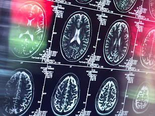 Johns Hopkins Study Reveals New Hope for Early Dementia Detection Using Advanced Brain Imaging