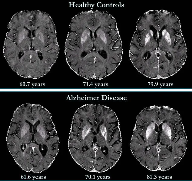 Johns Hopkins Study Reveals New Hope for Early Dementia Detection Using Advanced Brain Imaging