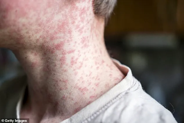 Measles Outbreak Linked to Utah Cycling Event: Four Unvaccinated Cases Confirmed, Officials Warn of More