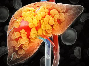 Silent Epidemic: 80-100 Million Americans May Have Undiagnosed Fatty Liver Disease, Experts Warn