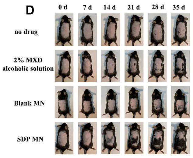 Study Reveals Potential New Approach to Hair Loss Treatment by Combining Stevia and Minoxidil
