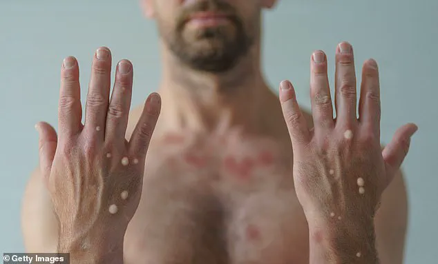 Third Case of Deadlier Clade I Mpox Detected in California, Raises Concerns About Local Transmission and Outbreak Potential