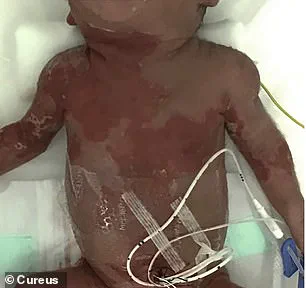 Silent Herpes Infection in Unaware Mother Results in Tragic Neonatal Death