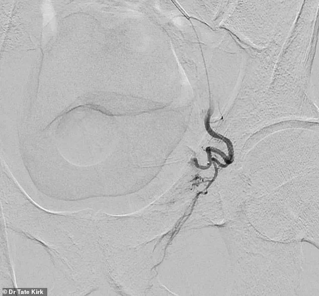 The Growing Burden of Benign Prostatic Hyperplasia on Men's Health in the United States