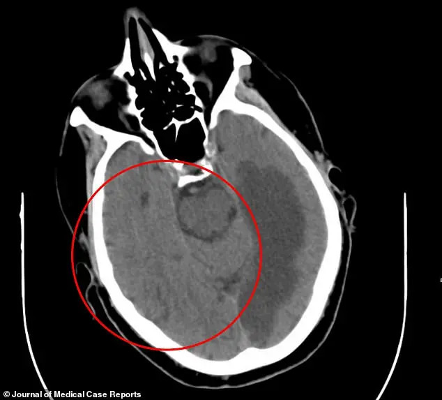 Exclusive Insight: The Baffling Case of Alien Hand Syndrome in Ireland