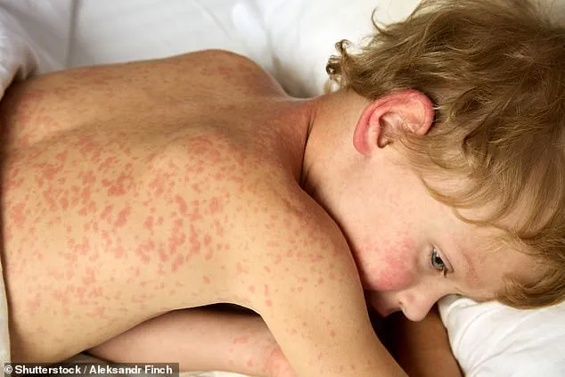 Measles Cases Surpass 2,000 in U.S. Crisis, Urgent Warnings as Virus Resurges