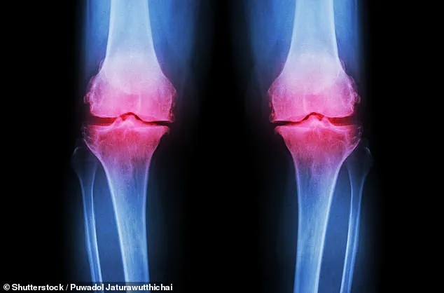 The Silent Epidemic: Osteoarthritis's Growing Impact on UK Public Health
