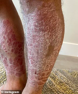 Exclusive Insights into Psoriasis Management: Expert Guidance for Public Well-Being