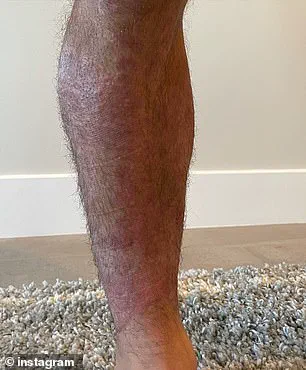 Exclusive Insights into Psoriasis Management: Expert Guidance for Public Well-Being