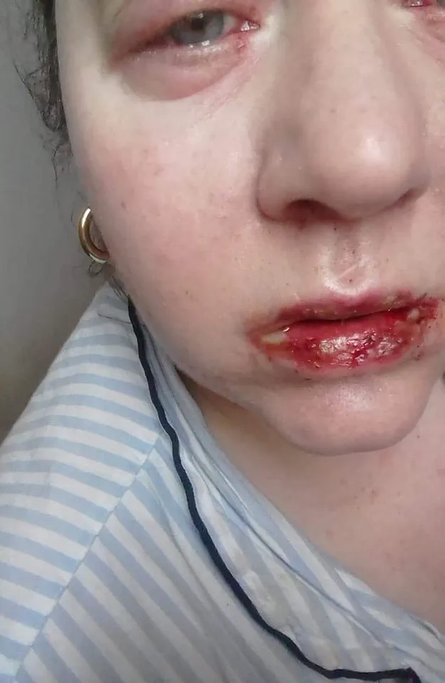 Benylin's Hidden Dangers: How a Common Cough Medicine Led to Life-Altering Consequences for One Woman