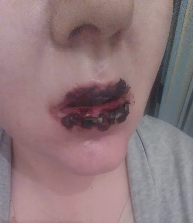 Benylin's Hidden Dangers: How a Common Cough Medicine Led to Life-Altering Consequences for One Woman