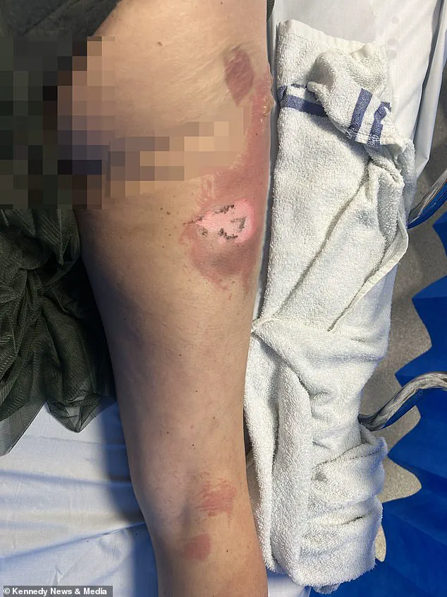 E-Cigarette Explosion Leaves Mother with Severe Burns and a Stark Warning About Device Safety
