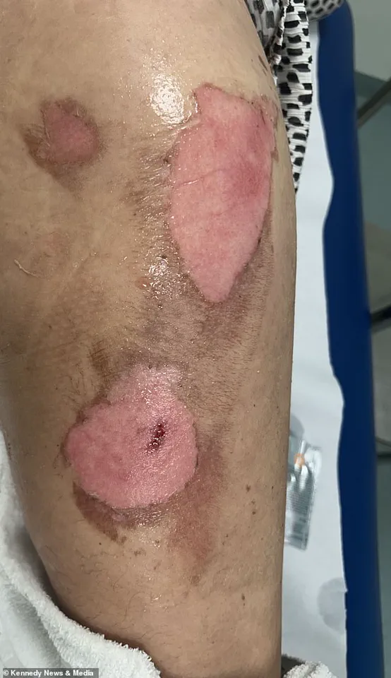 E-Cigarette Explosion Leaves Mother with Severe Burns and a Stark Warning About Device Safety