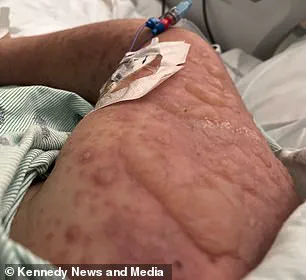 Behind Closed Doors: The Hidden Danger of Lamotrigine and the Medical Crisis That Changed Emily McAllister’s Life