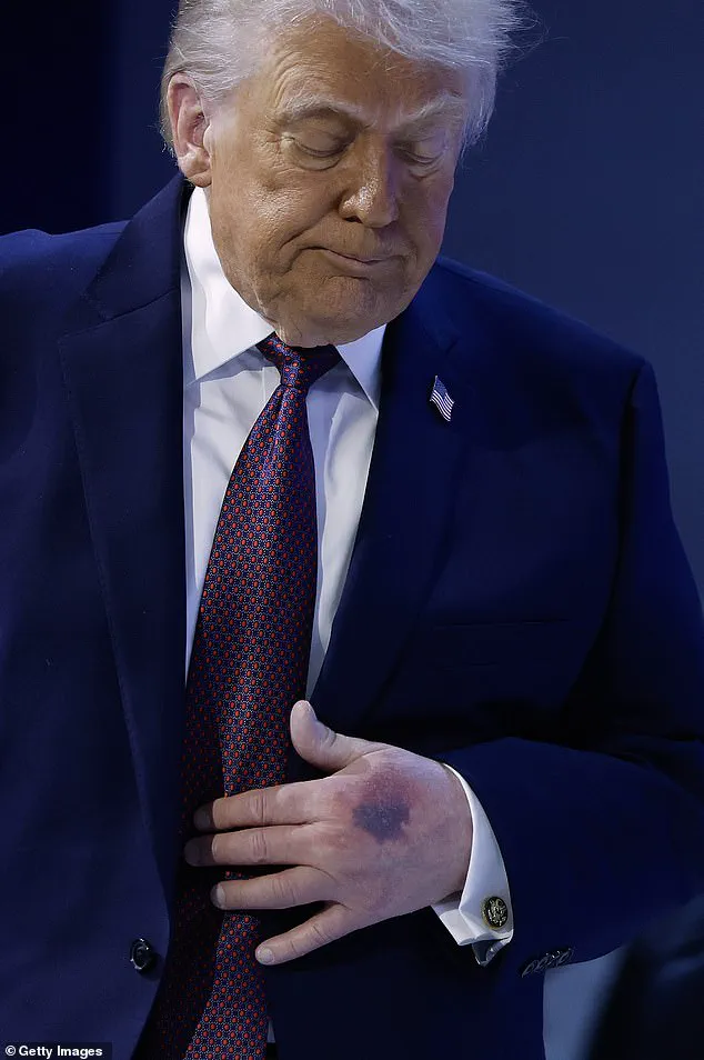 White House explains new bruise on President Trump's hand from Davos ceremony incident
