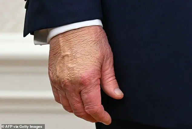 White House explains new bruise on President Trump's hand from Davos ceremony incident