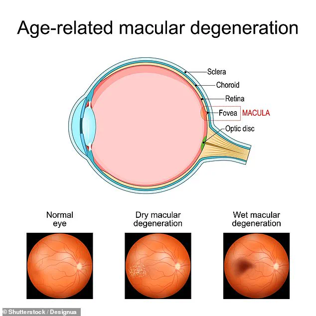 Groundbreaking Study Reveals Metformin May Offer Protection Against Leading Cause of Blindness in Older Adults