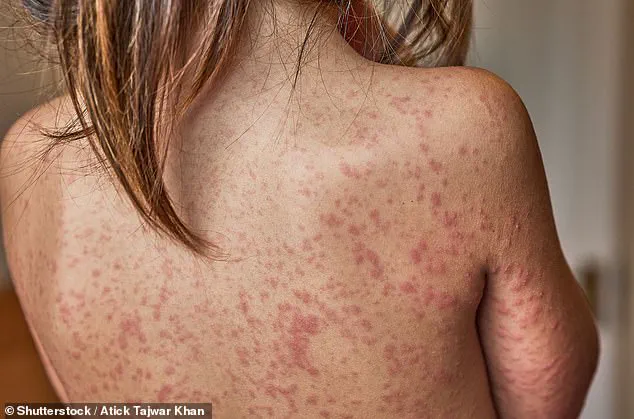 Measles Outbreak at California's Disney Parks: Third Case Reported, Exposure Window Identified