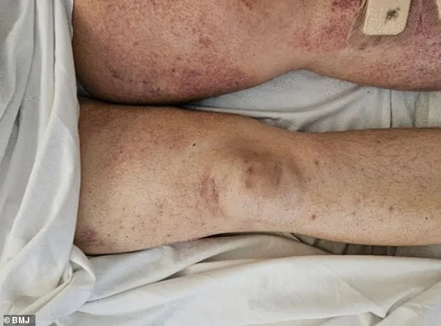 Scurvy's Resurgence in the UK Linked to GLP-1 Weight Loss Drugs Sparks Public Health Alert