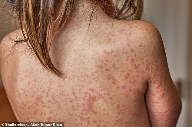 Trump Administration Urges Americans to Get Vaccinated as Measles Outbreak Sparks Urgency and Controversy
