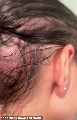 From Hair Loss to Health Crisis: The Mysterious Illness of a 28-Year-Old Student