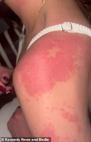 From Hair Loss to Health Crisis: The Mysterious Illness of a 28-Year-Old Student