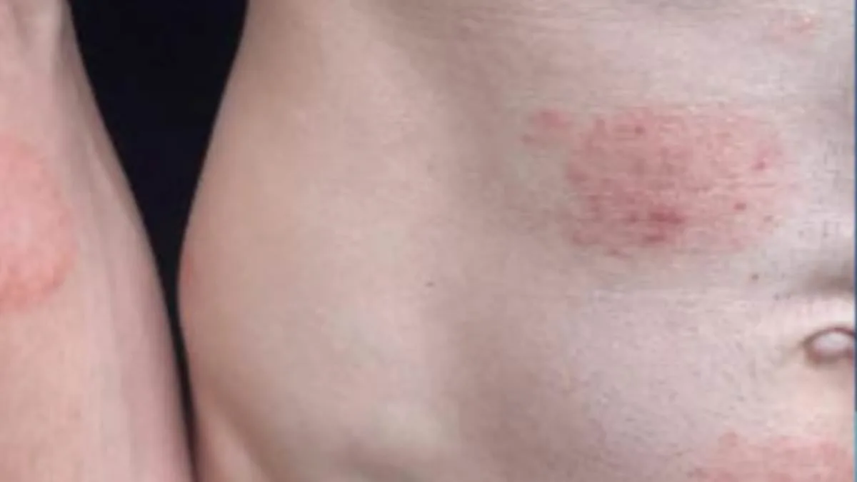 Minnesota's Largest Ringworm Outbreak Linked to Rare Fungus Sparks Health Alerts