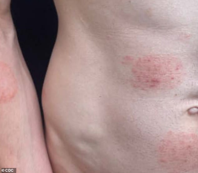 Minnesota's Largest Ringworm Outbreak Linked to Rare Fungus Sparks Health Alerts