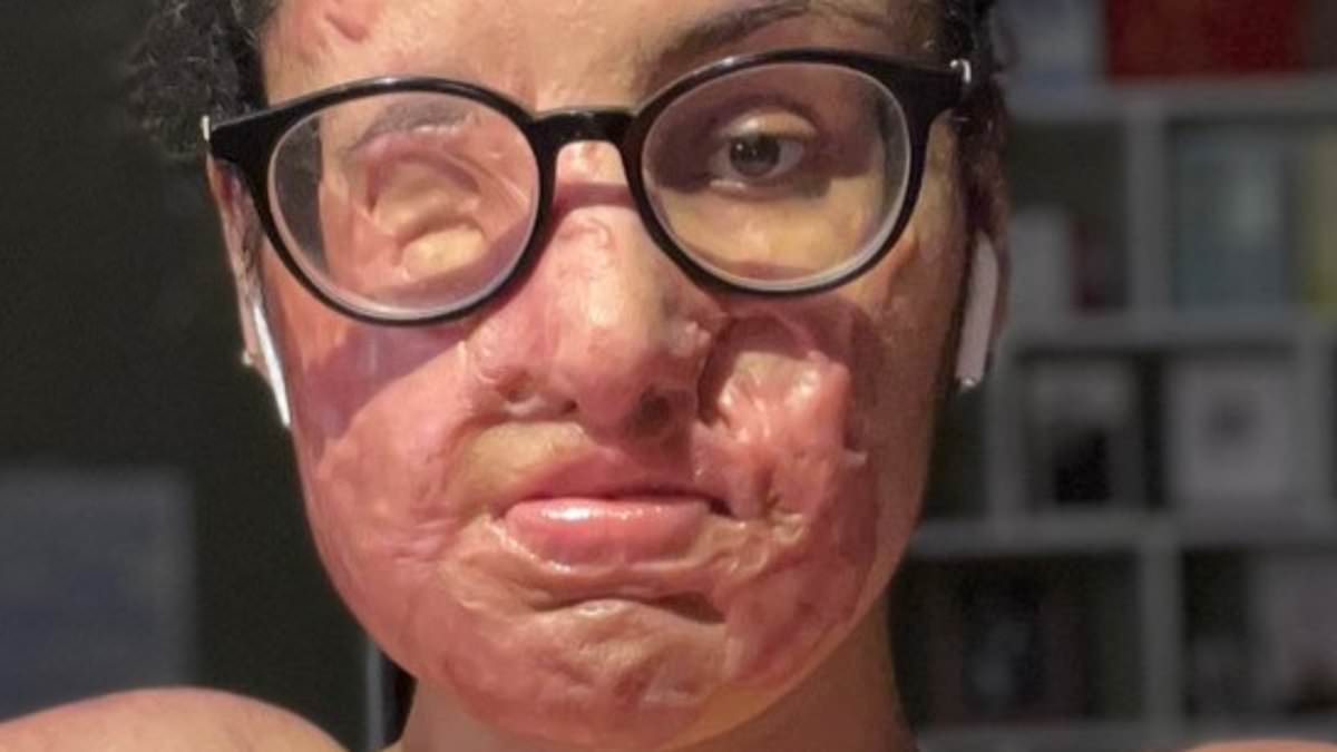 Terrell Campbell Indicted on First-Degree Charges for Brutal Sulfuric Acid Attack