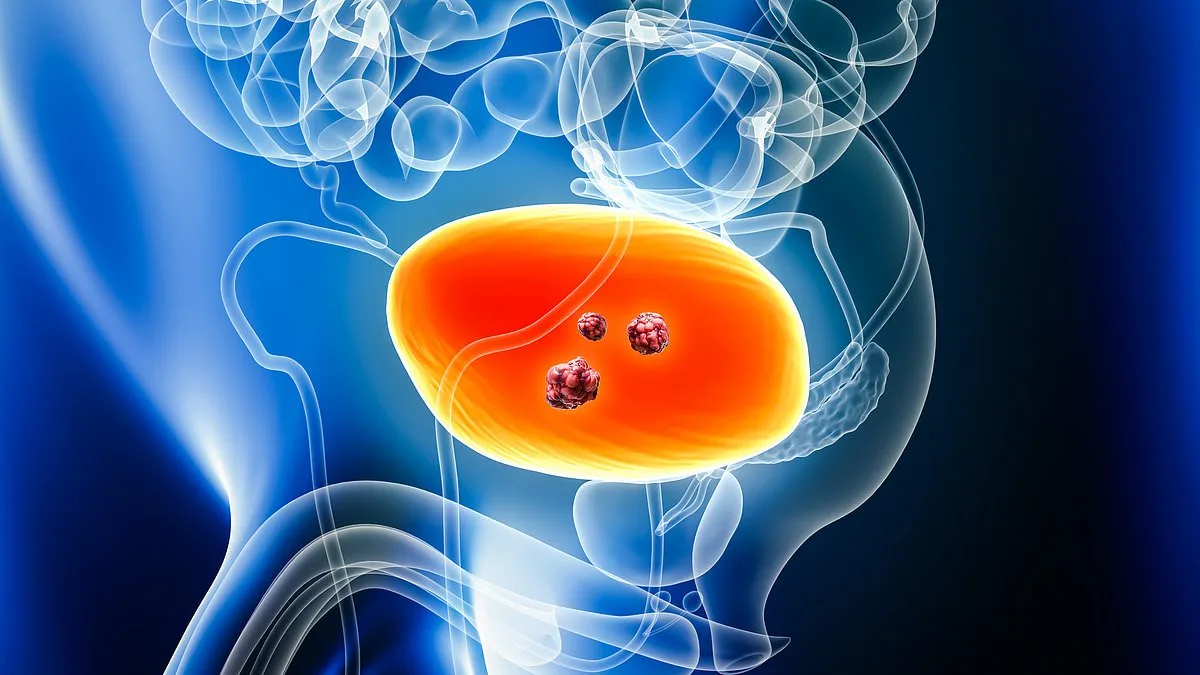 Breakthrough Treatment Approved on NHS Offers New Hope for Muscle-Invasive Bladder Cancer Patients
