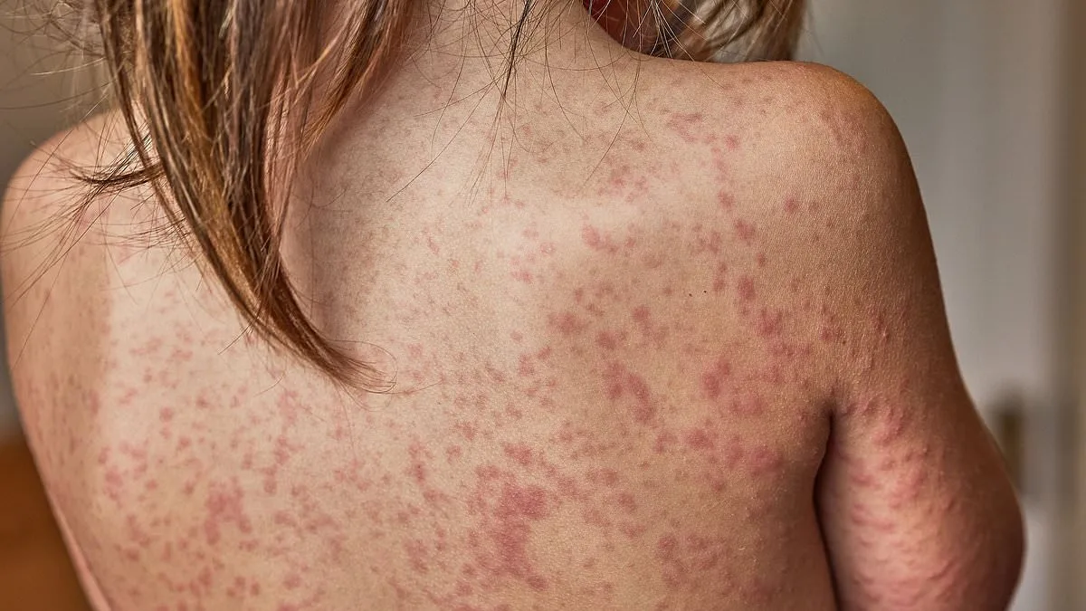 Measles Outbreak in London: Health Officials Declare Emergency as Cases Surge in Children