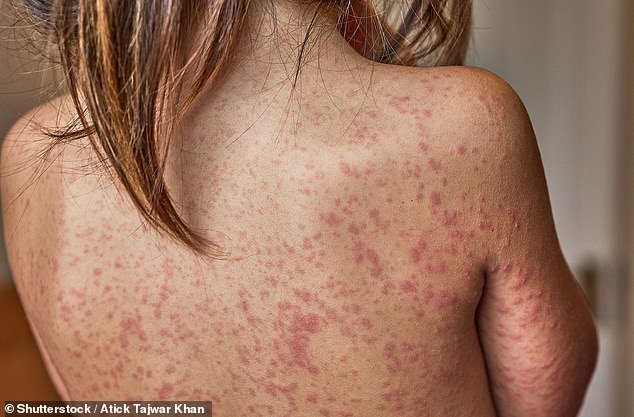 Measles Outbreak in London: Health Officials Declare Emergency as Cases Surge in Children