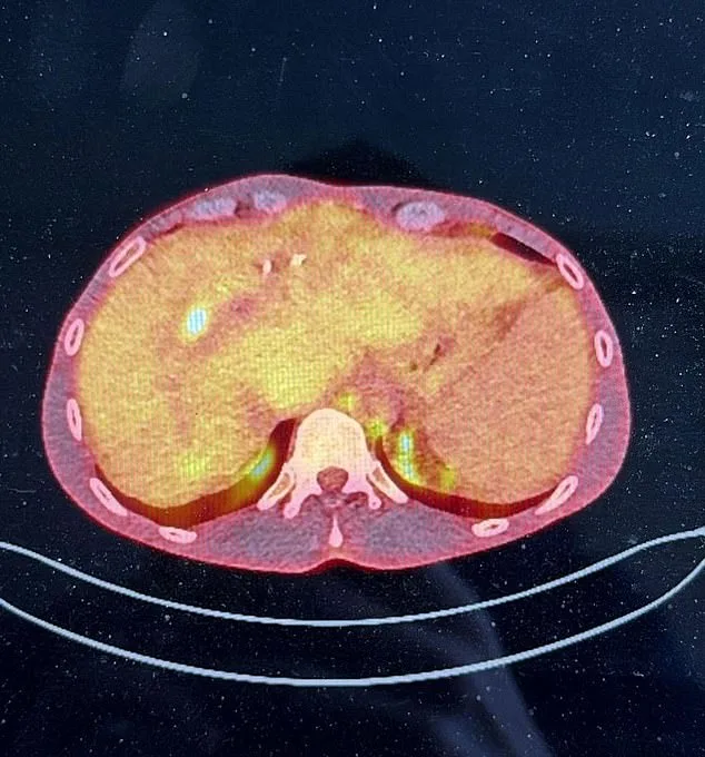 4mm Tumor Discrepancy Leaves Man with Rare Liver Disease Without Lifesaving Transplant