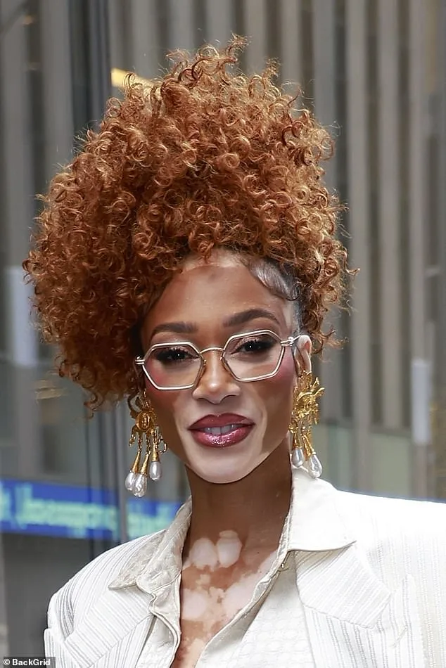 NHS Approves Groundbreaking Vitiligo Treatment, Offering Hope to 100,000 Britons