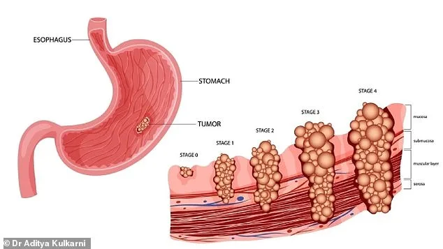Stomach Cancer's Alarming Resurgence: A Silent Killer Re-Emerging in Younger Generations