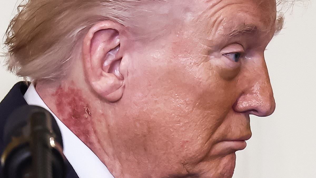 President Trump's Neck Rash Sparks Health Speculation Amid Preventative Treatment