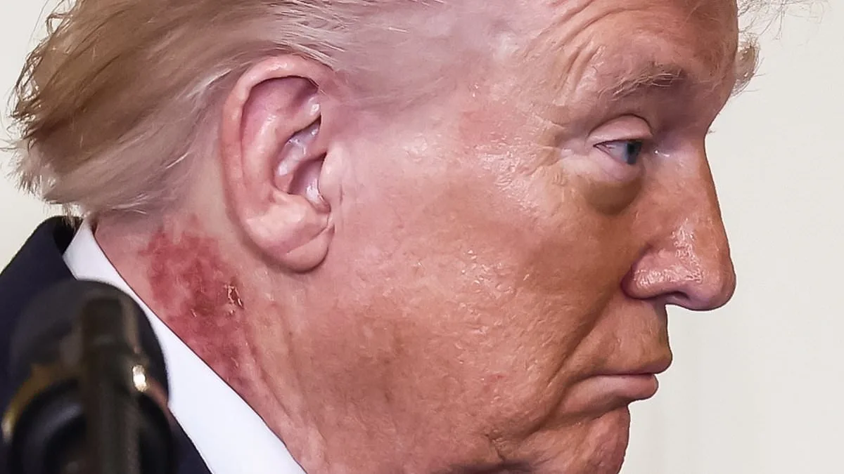 President Trump's Neck Rash Sparks Health Speculation Amid Preventative Treatment