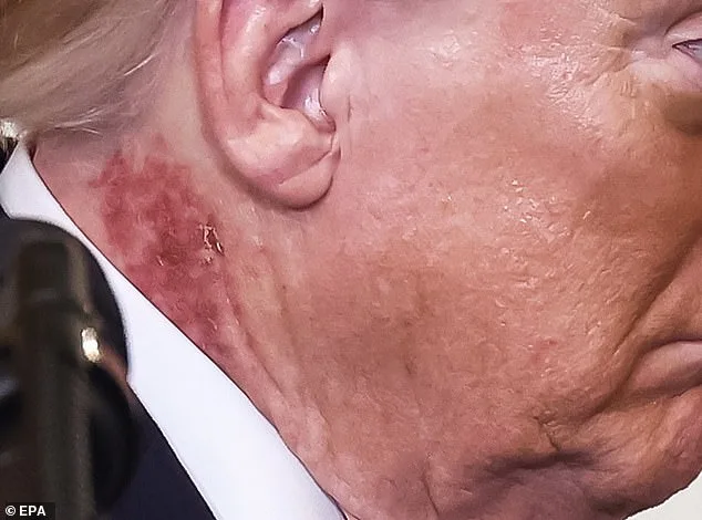 President Trump's Neck Rash Sparks Health Speculation Amid Preventative Treatment