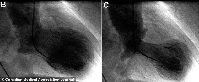 Stress-Induced Broken Heart Syndrome: New Insights in Cardiac Research