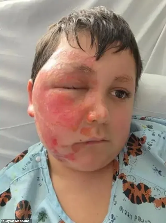 14-Year-Old Girl Severely Burned After Attempting TikTok-Inspired Fire-Breathing Challenge with Isopropyl Alcohol