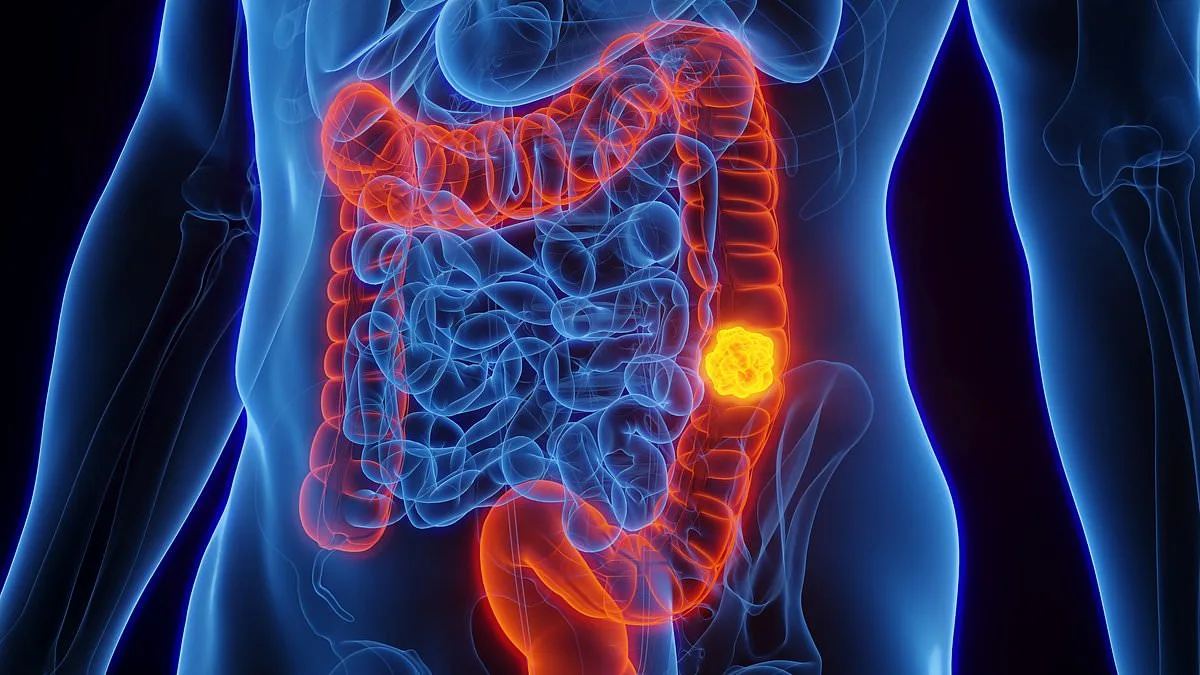 Bowel Cancer's Rising Threat: Younger Patients Face Growing Risk as Lifestyle Factors Fuel Surge