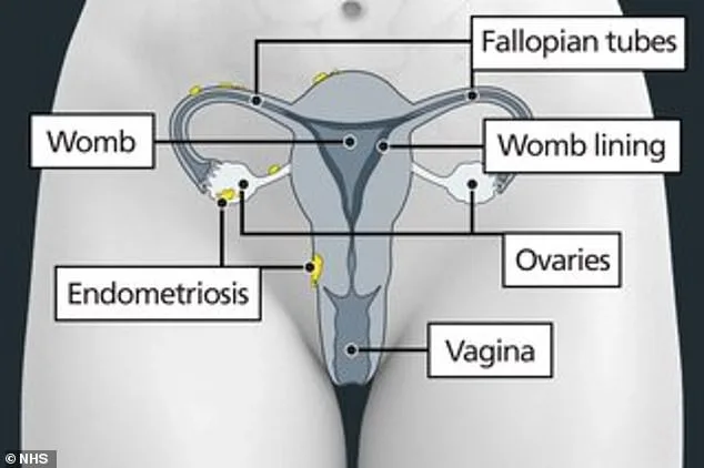 Groundbreaking Five-Minute Screening Tool for Endometriosis Developed at University of Queensland, Aiming to Transform Global Diagnosis