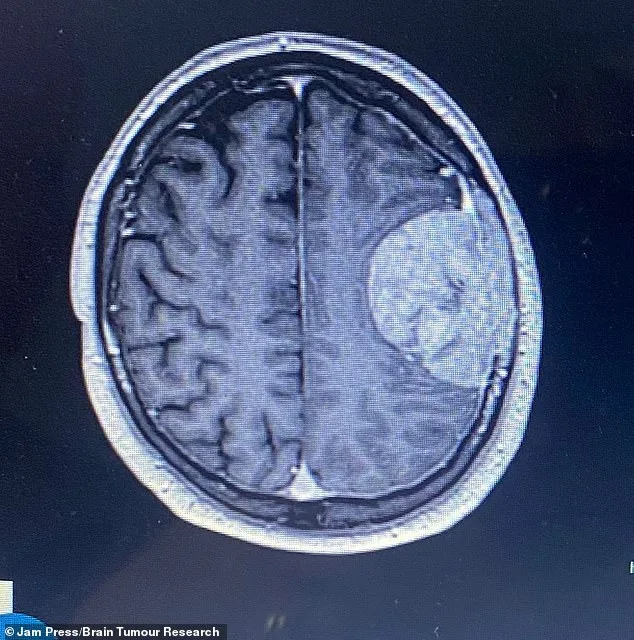 Stuart Hill's Silent Warning: How Decades of Migraines Masked a Life-Threatening Condition