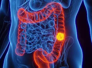 New Research Suggests Oral Health May Signal Bowel Cancer Risk