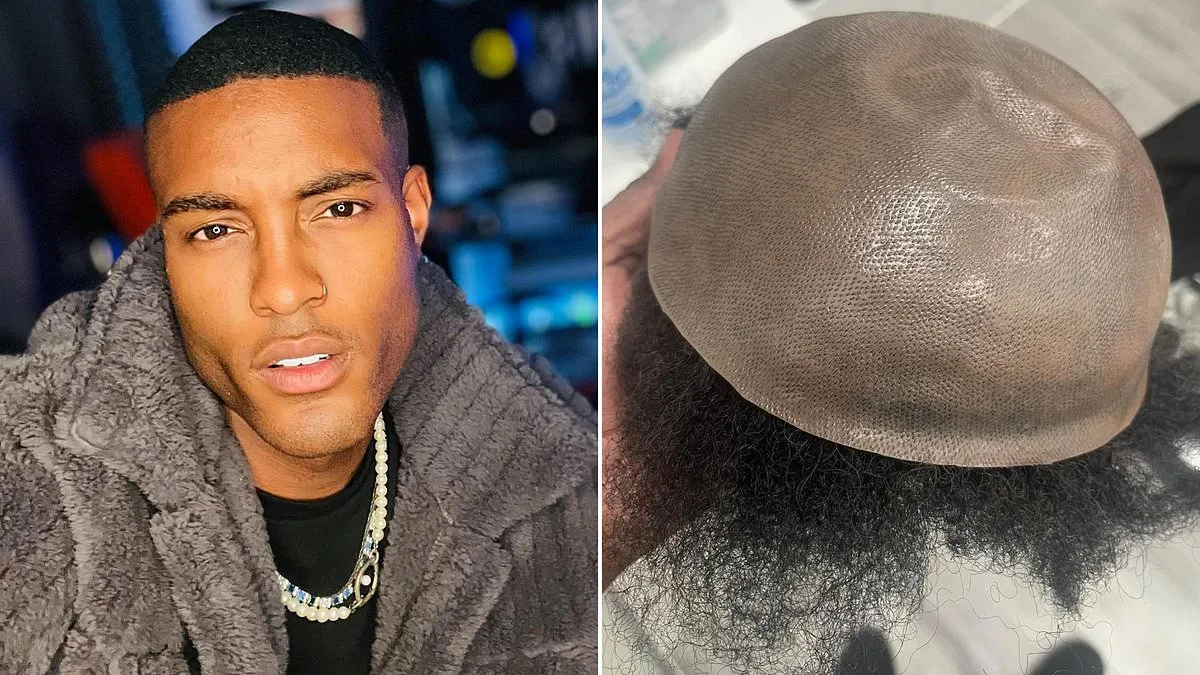 Mr Tinder' Reveals His 14-Year Secret: The Hair Transplant That Exposed His Baldness