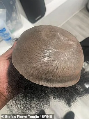 Mr Tinder' Reveals His 14-Year Secret: The Hair Transplant That Exposed His Baldness